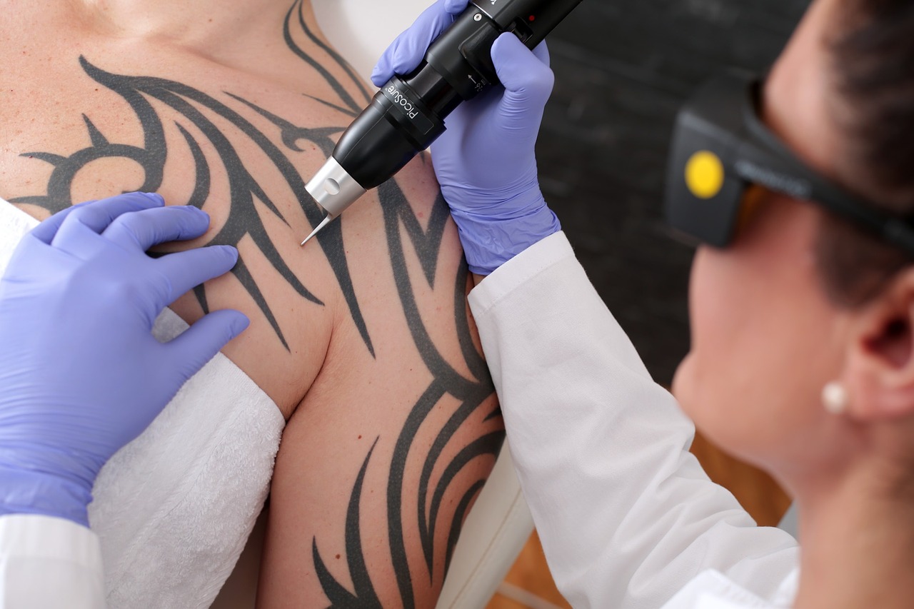 Price of Laser Tattoo Removal Made Simple